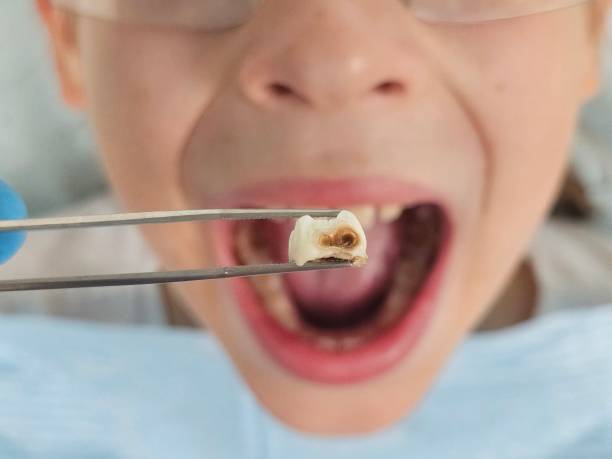 Urgent Tooth Repair in NC